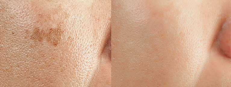 A close up of facial age spots before and after treatment