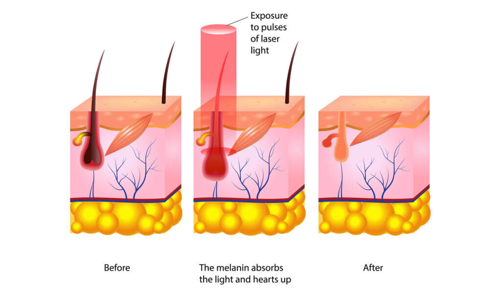 The process of laser hair removal on the bikini area