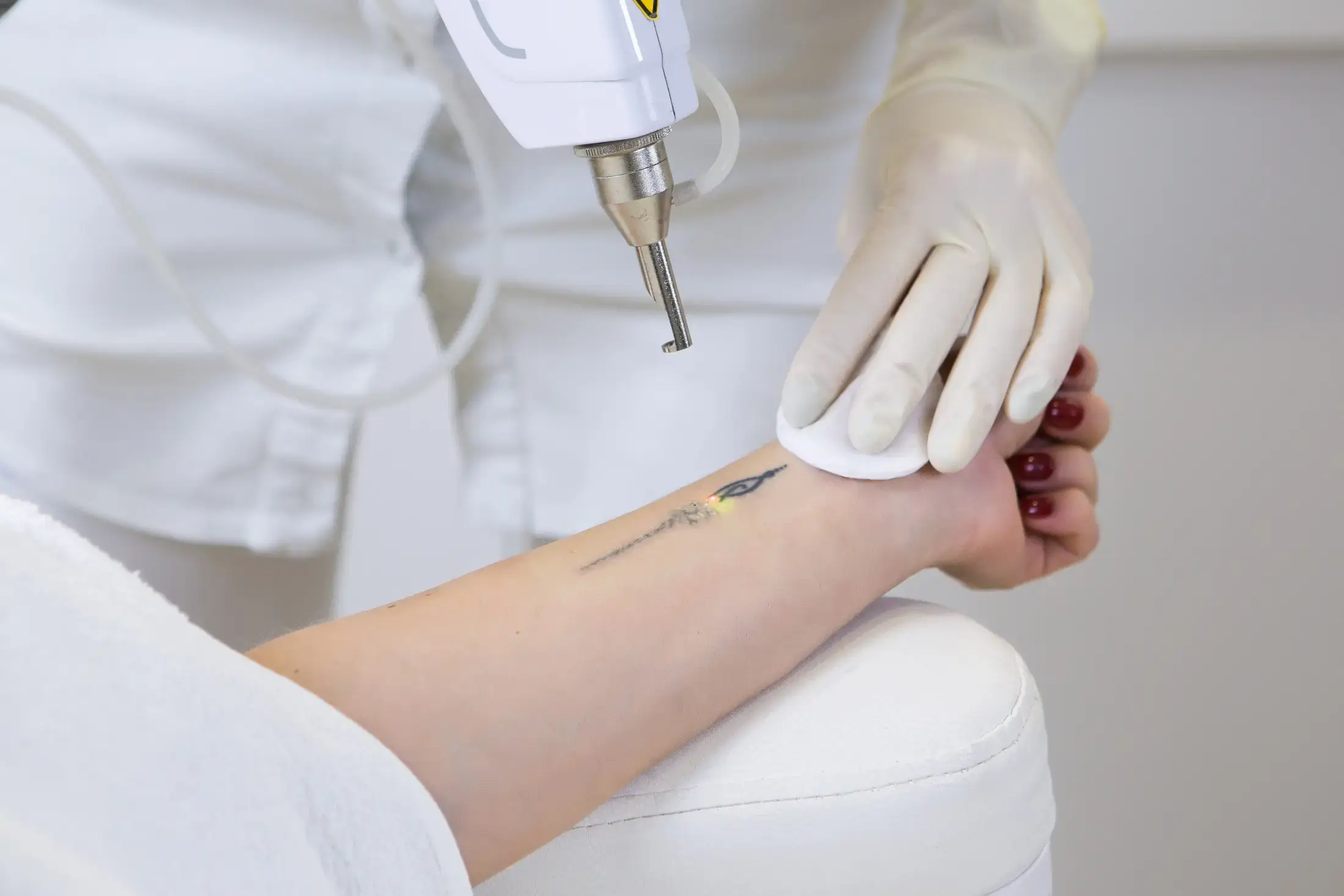 Is Laser Tattoo Removal Safe? Risks, Side Effects & What to Know