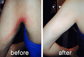 Red, itchy skin from allergies on arm before and after using Skinade