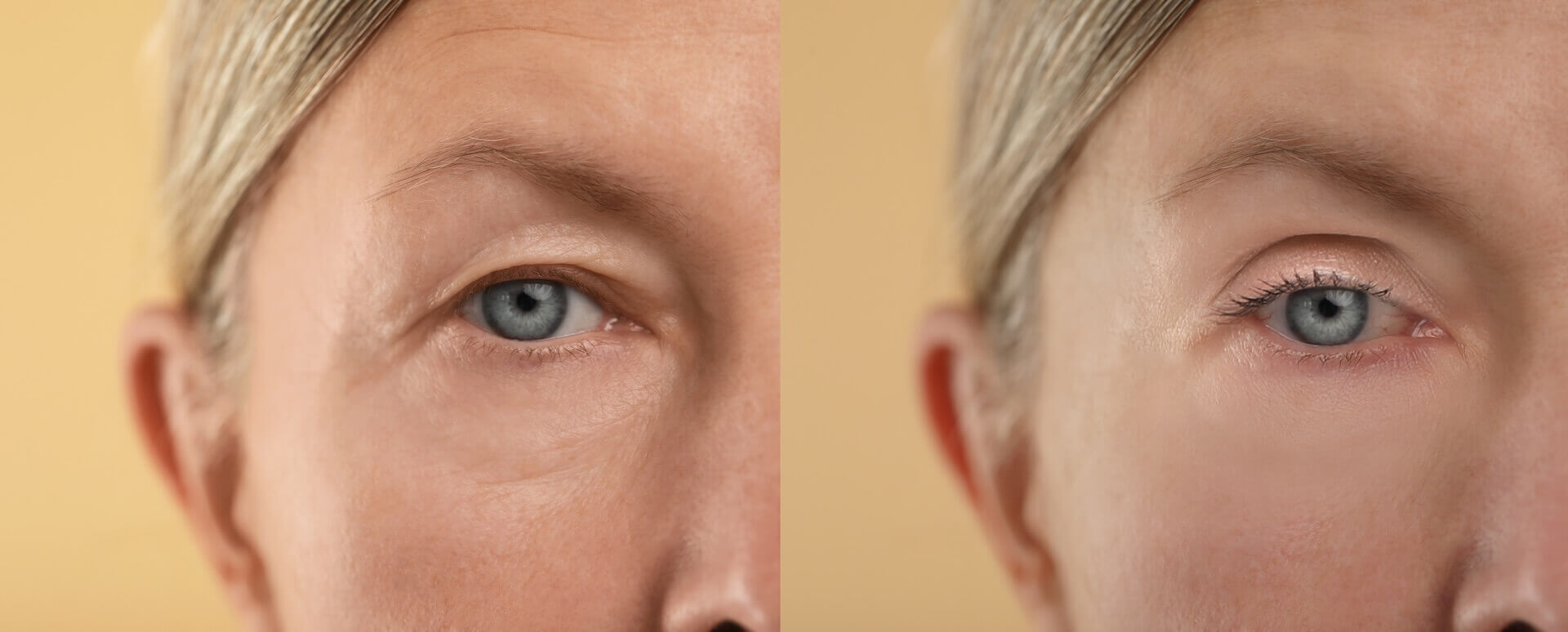 Blepharoplasty Recovery Timeline: What to Expect Week by Week